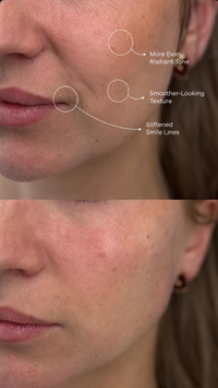Nenfy™ HXE-RICH Micro Infusion System