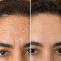 Nenfy™ HXE-RICH Micro Infusion System