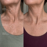 Nenfy™ HXE-RICH Micro Infusion System